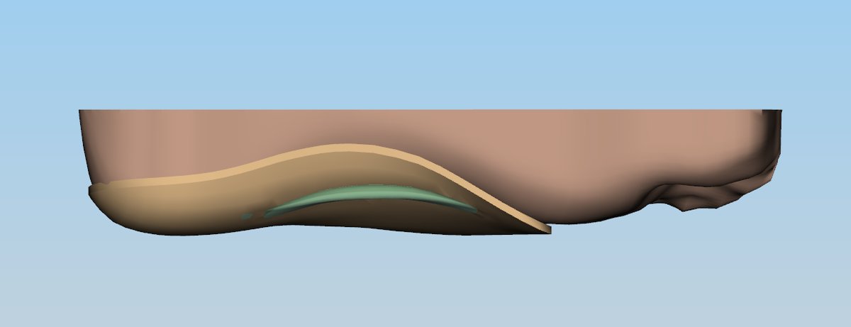 3D render of a custom orthotic device profile