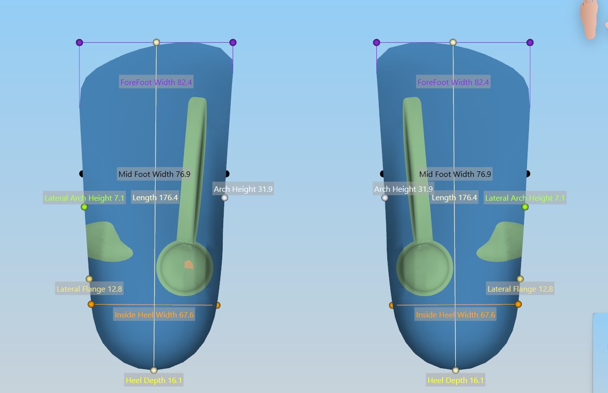 CAD/CAM design of custom orthotics with biomechanical measurements